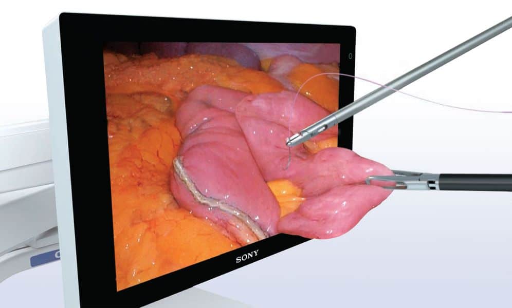 3D (Τρισδιάστατη) Λαπαροσκοπική Χειρουργική - Οθόνη τριών διαστάσεων (3D)
