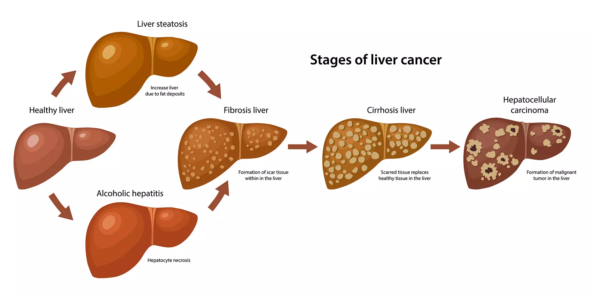Σχηματική απεικόνιση χρόνιας ηπατικής βλάβης, κίρρωσης και ηπατοκυτταρικού καρκινώματος