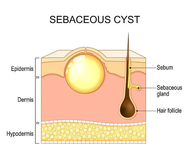 σμηγματογόνος κύστη